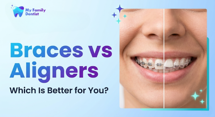 Braces vs Aligners: Which Is Better for You?