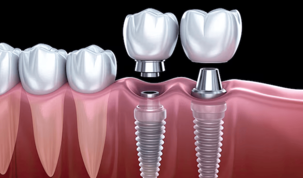 tooth-implant-process-what-to-expect